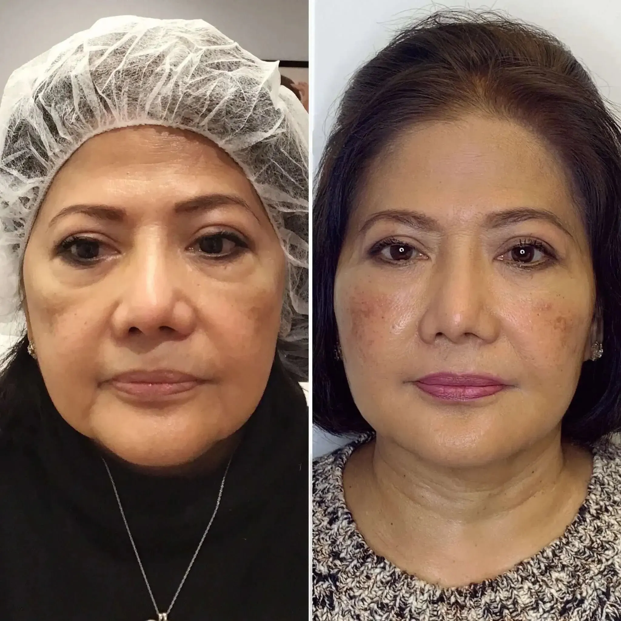 EyeFix: Filler