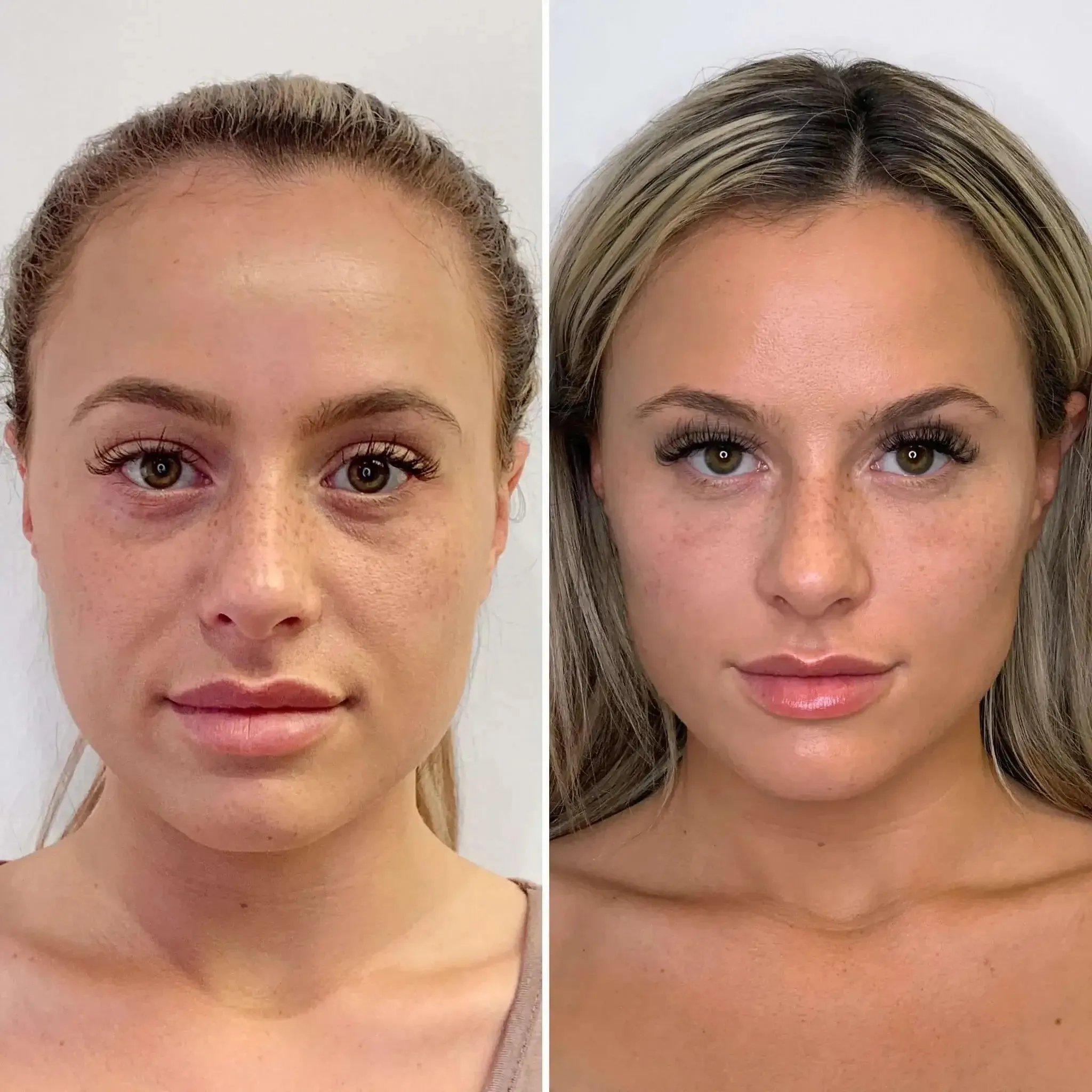 EyeFix: Filler