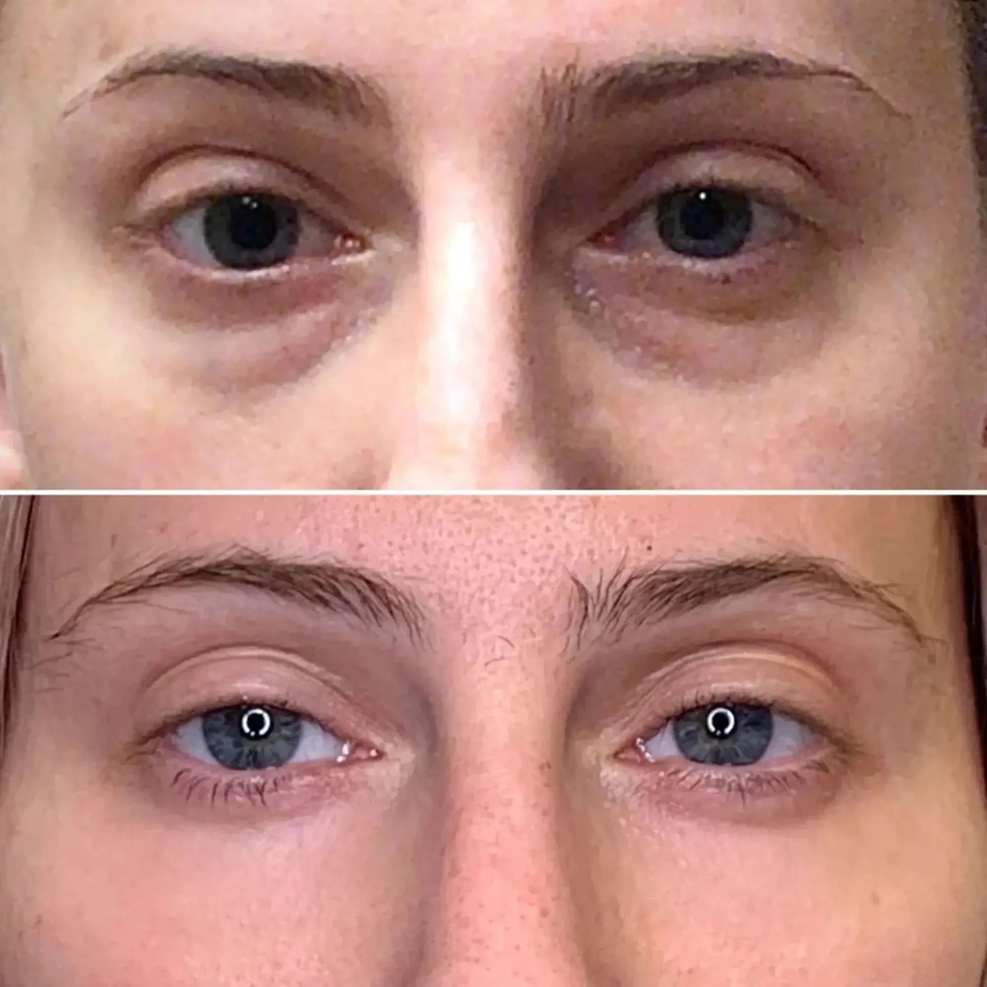EyeFix: Filler
