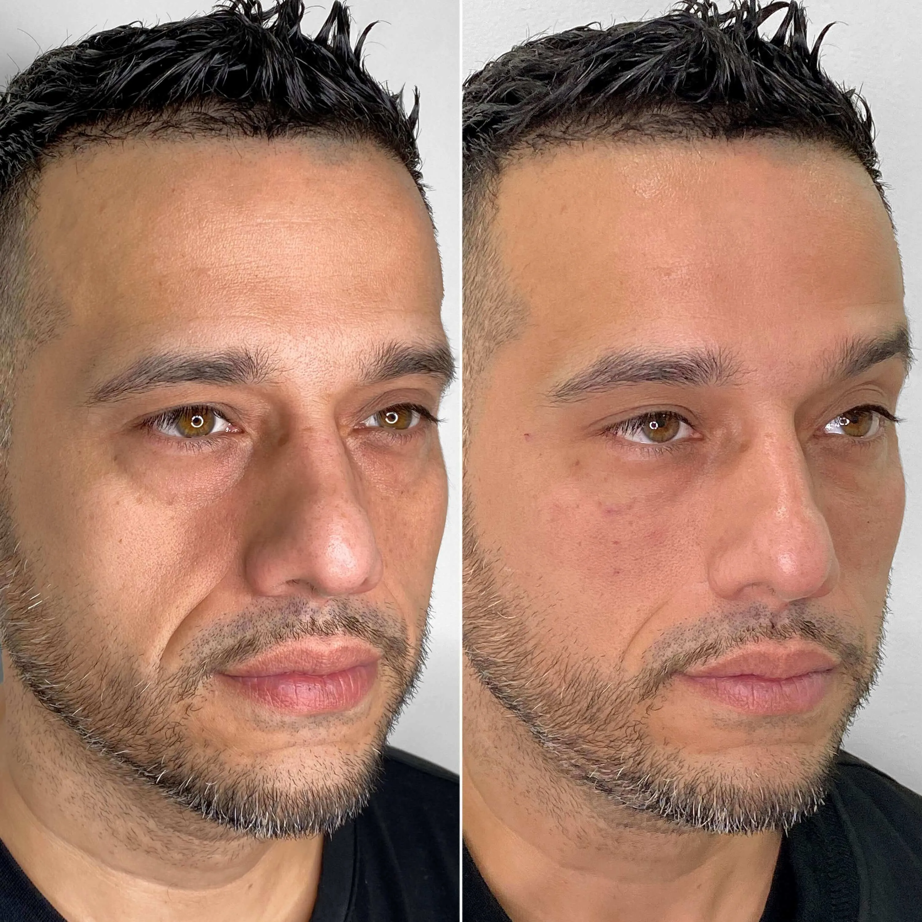 EyeFix: Filler