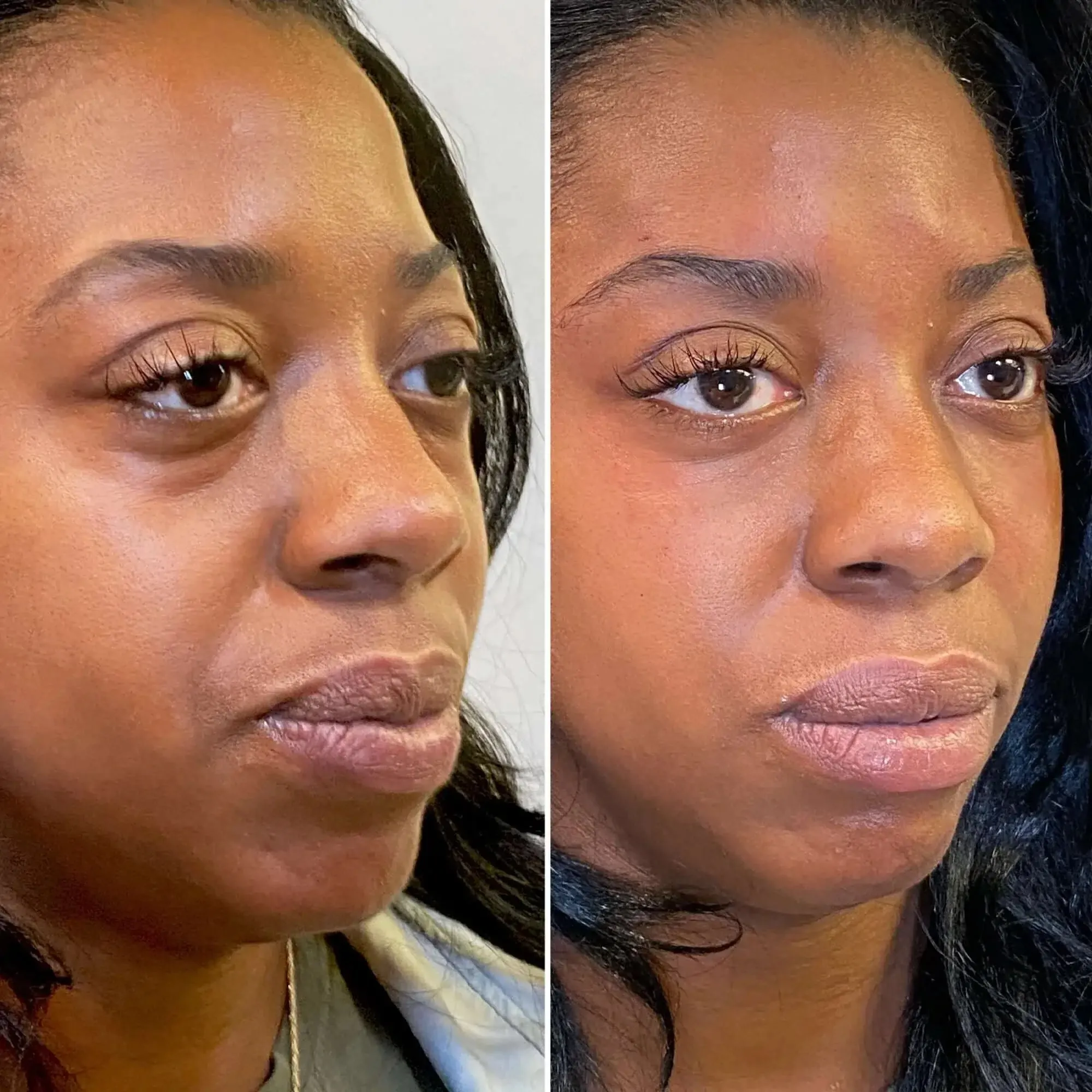 EyeFix: Filler