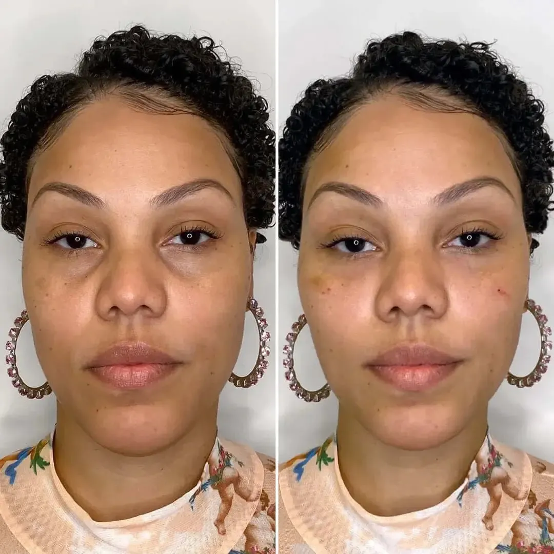 EyeFix: Filler